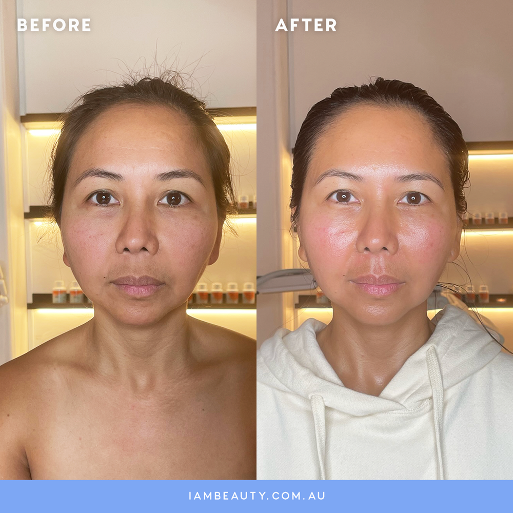Lymphatic & Buccal Facial Massage Before and After photos